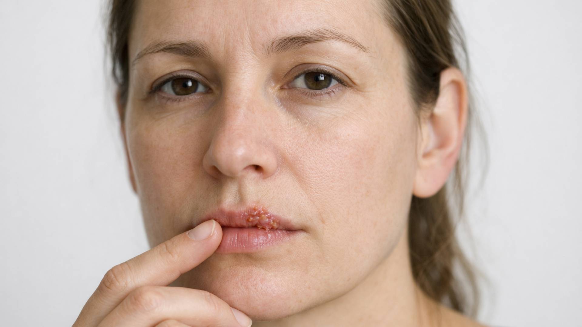 Uçuk (Herpes Virüs)